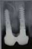Dental Implant S (3.75) - 7