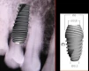 Perfect Titanium Implant (PFTI) 2.43 - 9
