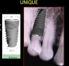 Unique Titanium Implant (UTI) 2.43 - 5