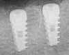 Paltop Active Implant PAI np - 2