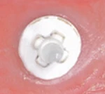 internal 4 interlocks, bolt it tube, regular platform (Keystone, Zeramex XT)