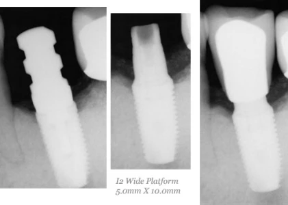 I2 Wide Platform (4.5)