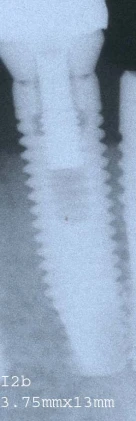 I2b Narrow Platform (3.75)