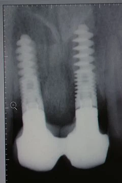 Dental Implant S (3.75)