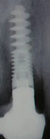 Dental Implant S (3.75)