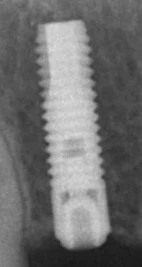 OsseoSpeed S (3.5,4.0)