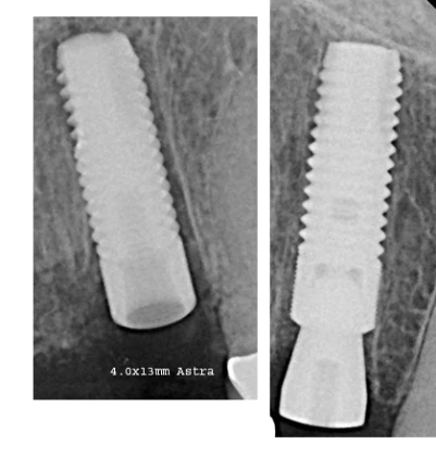 OsseoSpeed S (3.5,4.0)