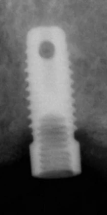 Steri-Oss Original MD (3.5,3.8,4.0)