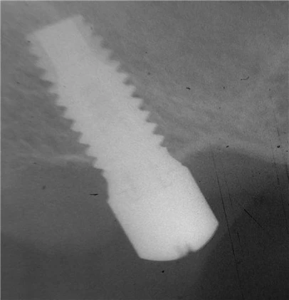 External Hexagonal Cylindrical (4.1)