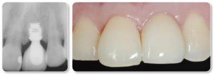 Integra-CP/NanoTite (3.0)