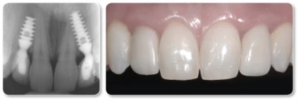 Integra-CP/NanoTite (2.0)