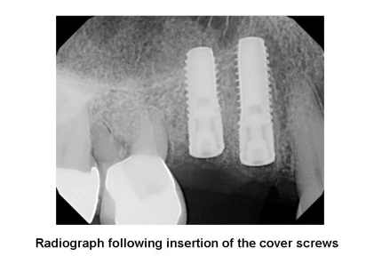 Bone Level-BL B2 (3.1)