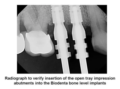 Bone Level-BL B2 (3.1)
