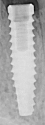 Tapered Internal Plus (3.5)