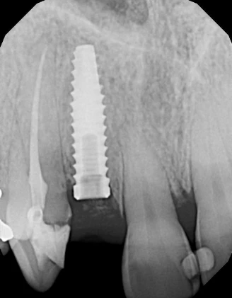 Tapered Internal Plus (3.5)