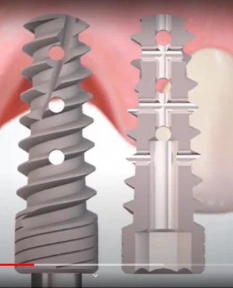 MAI Maintained Active Implant (3.5)