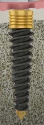 i-Implant Pterygoid Implant