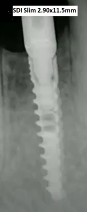 SDI Slim Spiral Implant (2.9)