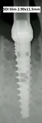 SDI Slim Spiral Implant (2.9)