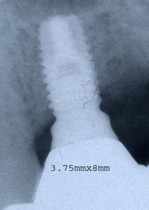 Full OSSEOTITE Parallel Walled (4.1)