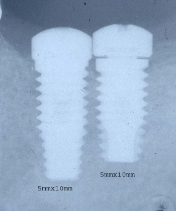 Full OSSEOTITE Parallel Walled (5.0)