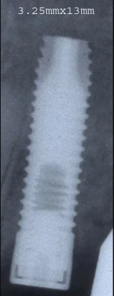 Full OSSEOTITE Parallel Walled (3.4)