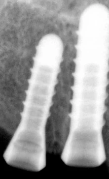 One Stage Regular Platform (4.8)