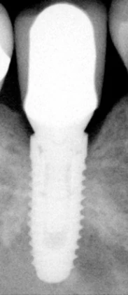 Two Stage Trilobe (4.3)