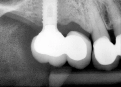 One Stage Wide Platform (6.5)