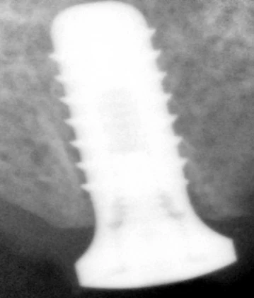 One Stage Wide Platform (6.5)