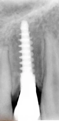 StableDent Post Implant