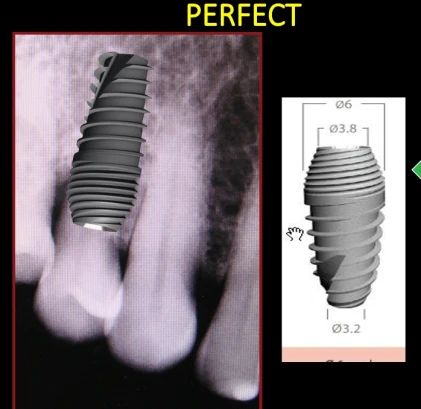 Perfect Titanium Implant (PFTI) 2.43