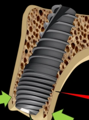 Perfect Titanium Implant (PFTI) 2.43