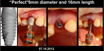 Perfect Titanium Implant (PFTI) 2.43