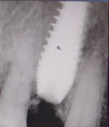 Perfect Titanium Implant (PFTI) 2.1