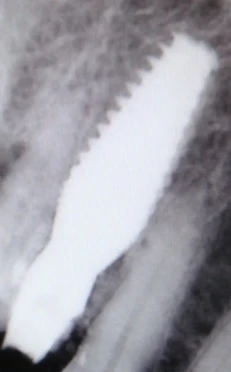 Perfect Titanium Implant (PFTI) 2.1