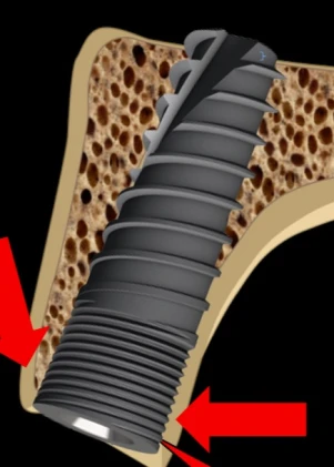 Unique Titanium Implant (UTI) 2.43