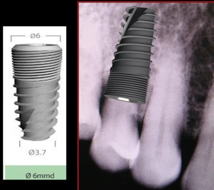 Unique Titanium Implant (UTI) 2.43