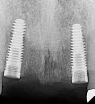 Inclusive Tapered (3.5)