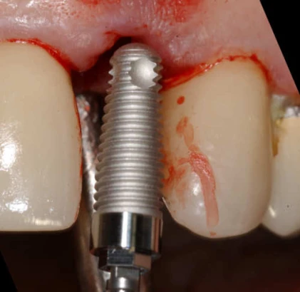 External Hex Conic 4.3