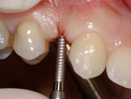 MDL (Mini Drive-Lock)