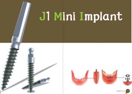 J1 Mini Implant