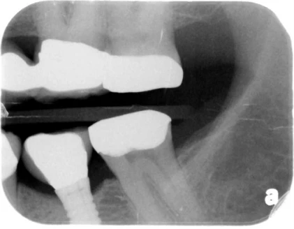 Sustain Cylinder External Hex WD (5.0)