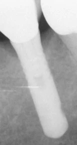 Sustain Cylinder External Hex WD (5.0)