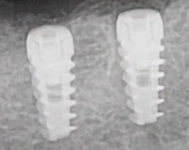 Paltop Active Implant PAI TC wp