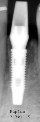 EZ Plus Internal Small (3.5)