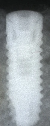 BioCom Internal hexagon-standard platform (3.75)