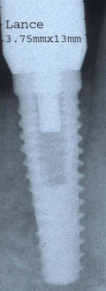 Lance External hexagon Standard Platform (4.1)