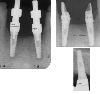 Lance External hexagon Standard Platform (4.1)