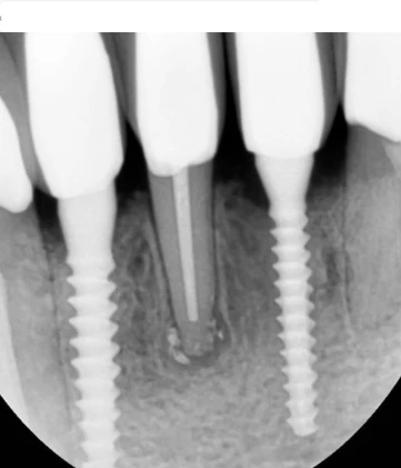 S-Mini Cemented Type